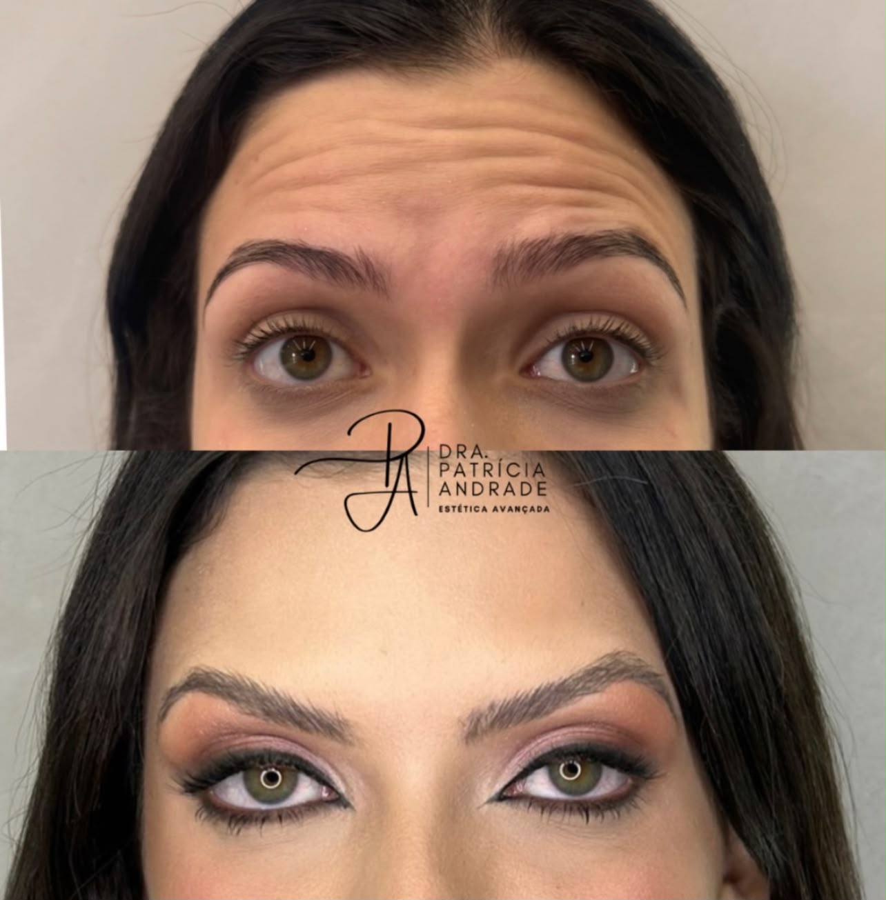 Resultado — Botox