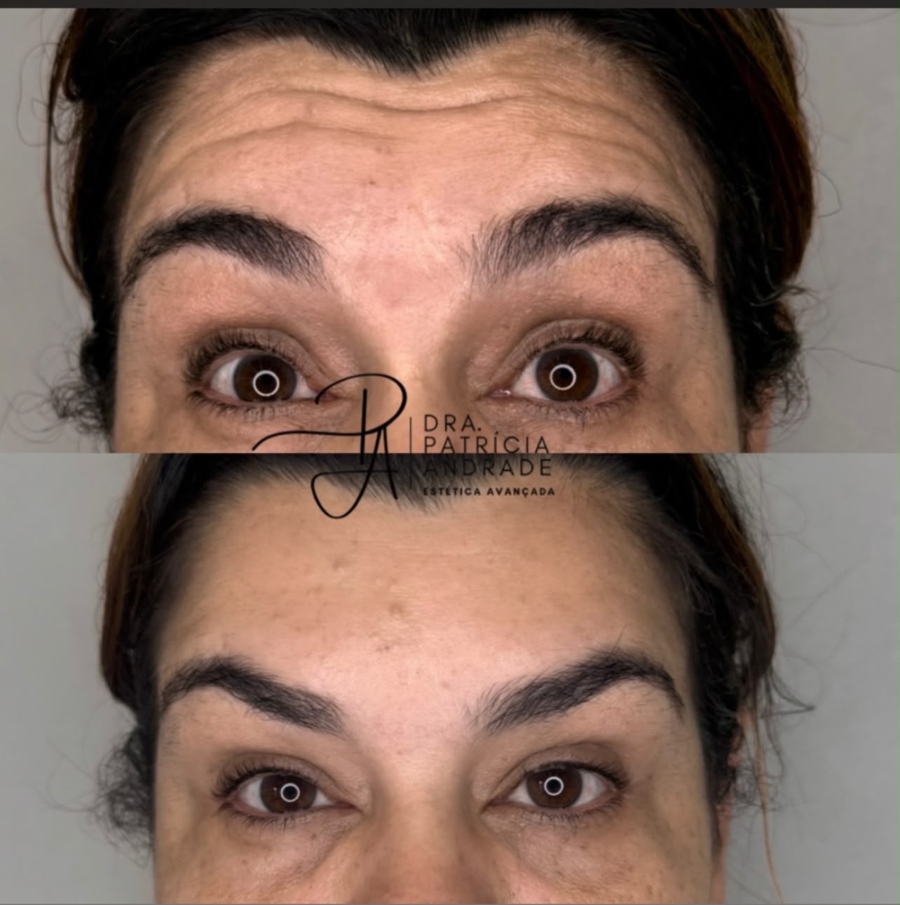 Resultado — Botox