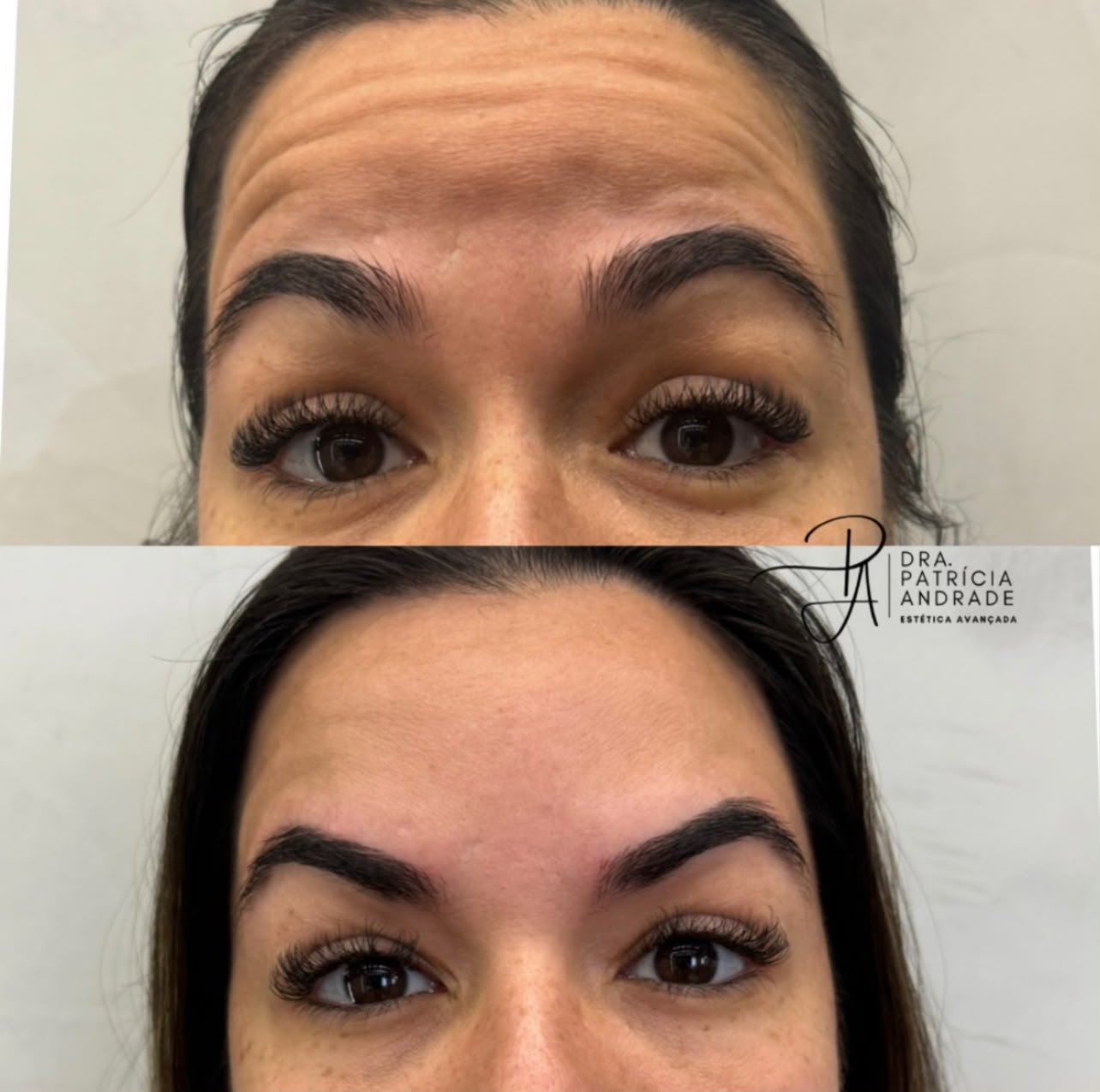 Resultado — Botox