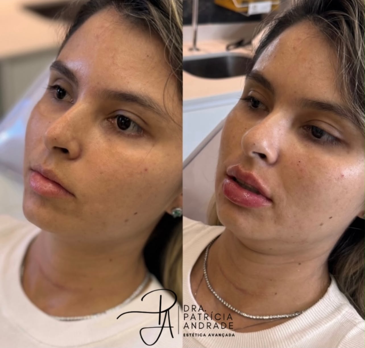 Resultado — Preenchimento Labial